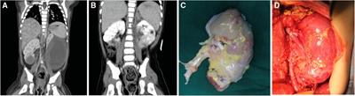 Ex vivo tumor dissection followed by kidney autotransplantation in bilateral wilms tumor